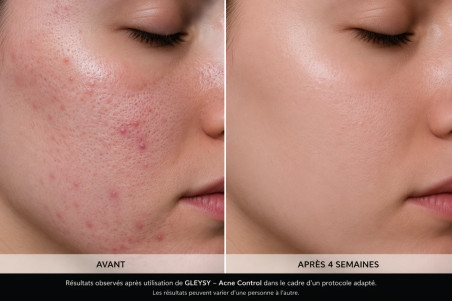 GLEYSY Acne Control : Complexe professionnel pour peaux à imperfections | 5 flacons de 10ml