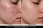 GLEYSY Acne Control : Complexe professionnel pour peaux à imperfections | 5 flacons de 10ml