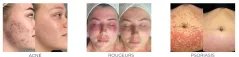 DERMALUX FLEX MD : Dispositif LED pour Rajeunissement Cutané, Acné et Cicatrisation